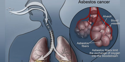Long Term Asbestos Exposure And Its Cancer Risks